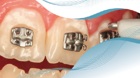 Cuidado de las Pr&oacute;tesis Dentales